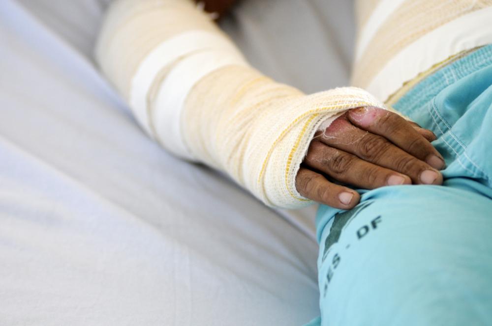 Queimaduras de terceiro grau podem levar ao comprometimento de tendão, nervo e osso